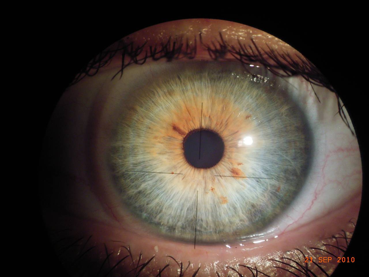 Augen- und Irisdiagnose